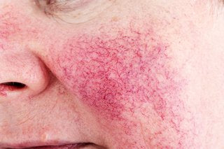 Discover the essential facts about Rosacea, including its causes, symptoms, and effective treatment