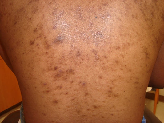 Understanding Hyperpigmentation: Causes, Treatments, and Prevention