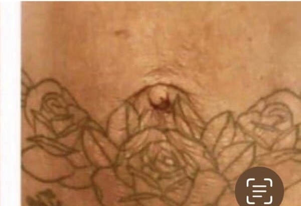 Keisha, 29 after using Stretch Mark Kit