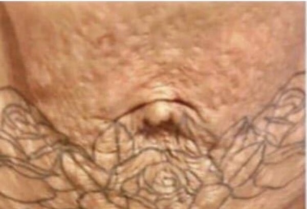 Keisha, 29 before using Stretch Mark Kit