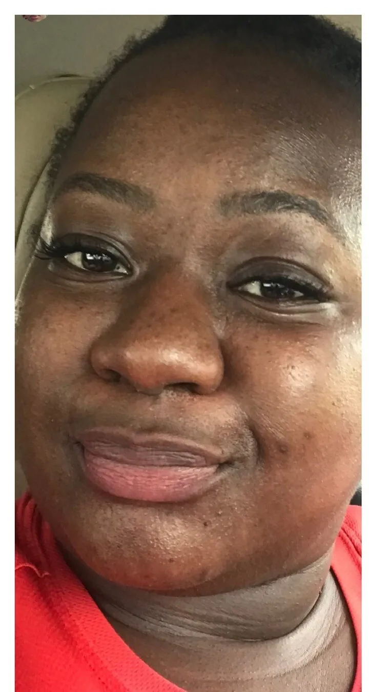 Monica, 38 before starting the Magic Skin Repair Magic Serum ritual — baseline photo of scars and stretch marks prior to treatment