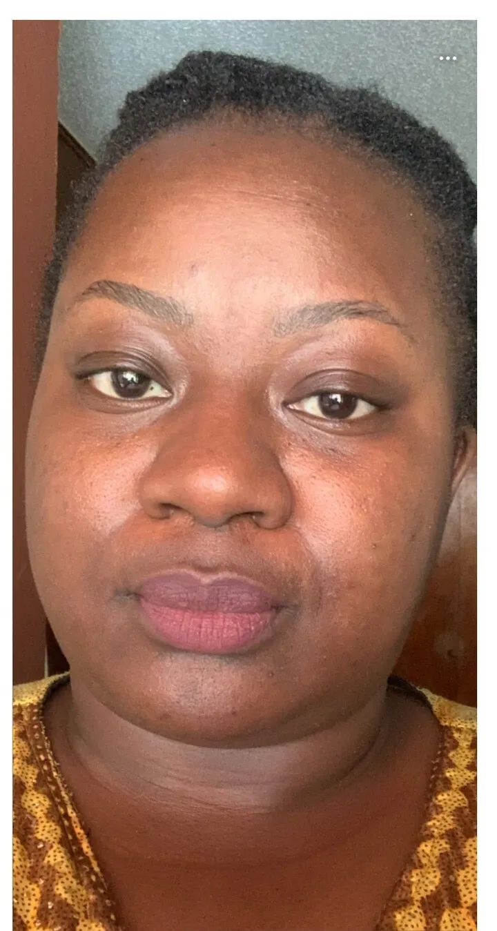 Before and after transformation results showing visibly reduced scars and uneven tone after 6 weeks of using Magic Serum from Magic Skin Repair — Monica, 38 (after)