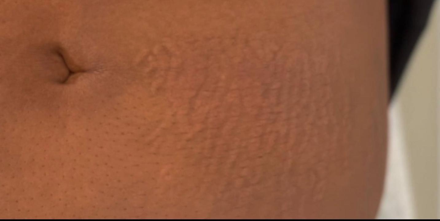 Jasmine, 32 after using Magic Serum + Body Butter