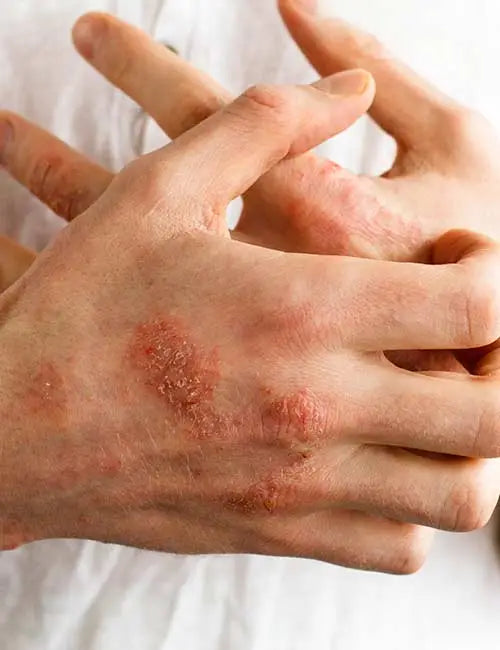 Explore the causes, treatments, and effective management strategies for eczema, also known as atopic