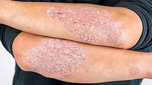 Explore the causes, symptoms, and treatments of Psoriasis, a chronic skin condition that leads to ra