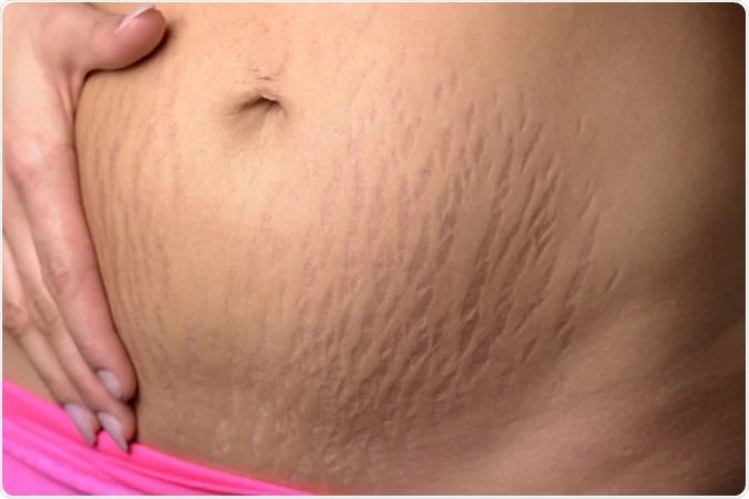 Understanding Stretch Marks: Causes, Treatments, and Prevention