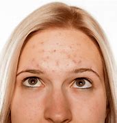 Discover the best acne treatment strategies for achieving clearer skin, with insights on the causes,